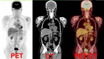 PET與PET/CT的比較